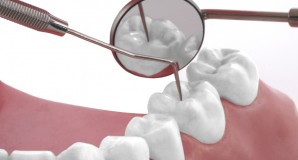 Parodontitisbehandlung und Mundhygiene