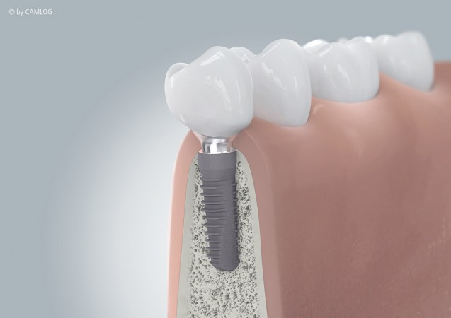 Implantate als fixer Zahnersatz oder zur Prothesenverankerung