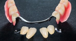 Abnehmbarer Zahnersatz mittels Prothesen