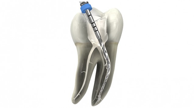 Wurzelbehandlung, Endodontie